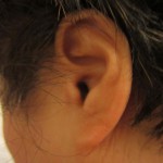 Cos’è l’acufene